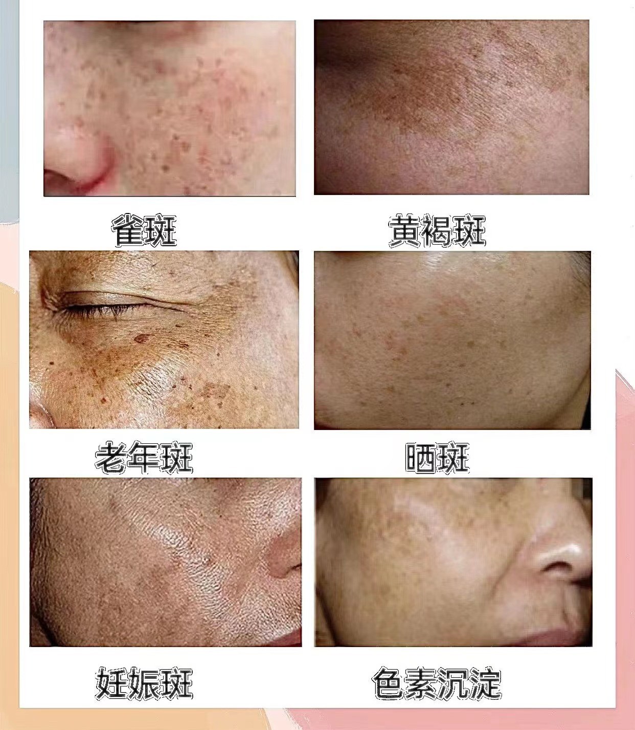 护肤专家刘庄彬的斑点专业解析(图1)