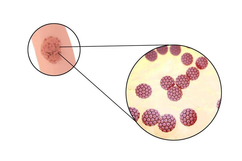 LAIFE乐梵提供防治宫颈癌最大诱因HPV新思路