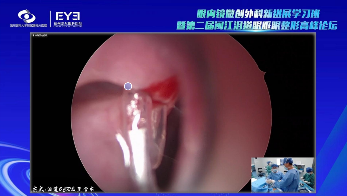 国家级继教班“第二届闽江泪道眼眶眼整形高峰论坛”在榕举办